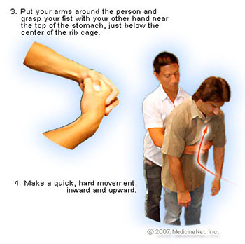 Prosedur Heimlich Maneuver
